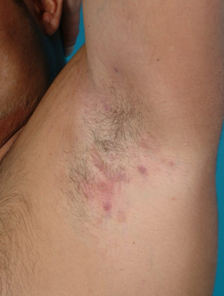 Hidradenitis suppurativa on patients armpit