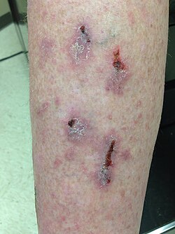 leg with lichen planus in bridgewater nj