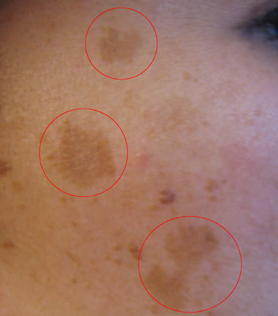 melasma on patient's face