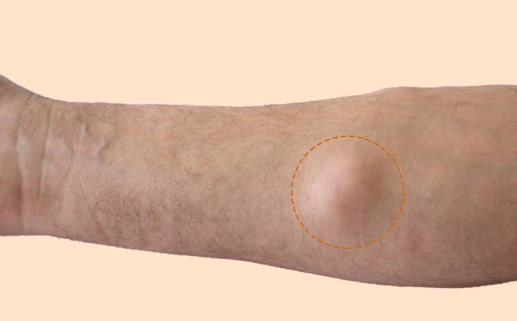 Lipoma on patients arm
