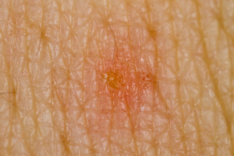 patient with scabies