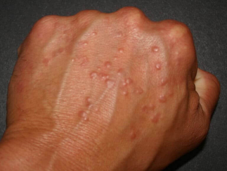 Granuloma annulare on hand