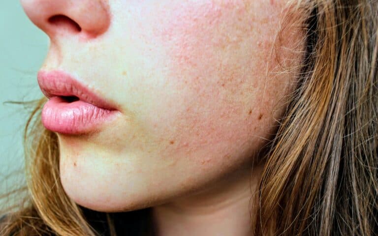 woman with dry skin on her face