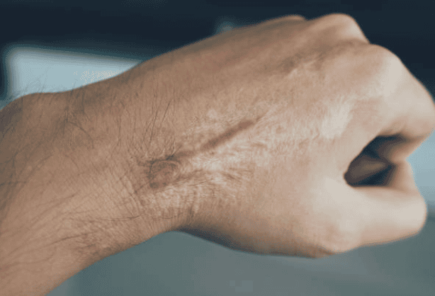 patient with scar on hand