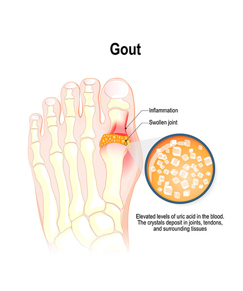 Gout diagram