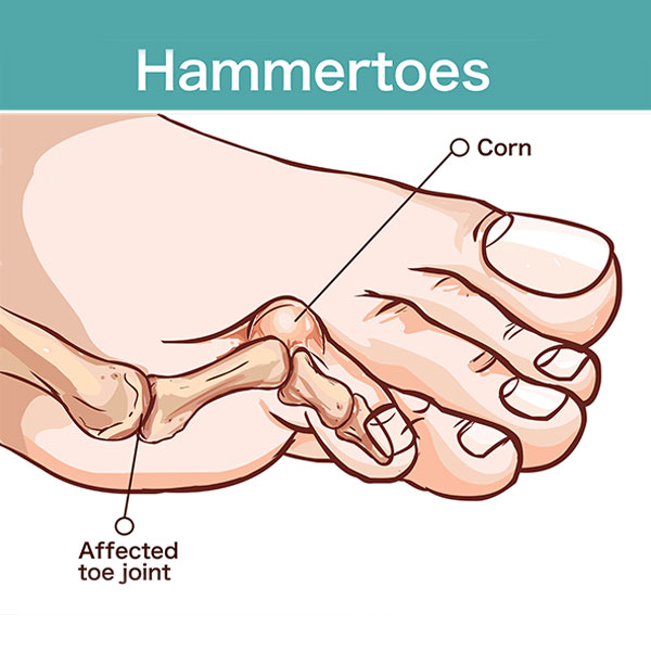 Hammertoe diagram