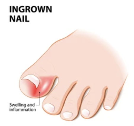 Ingrown toenail diagram