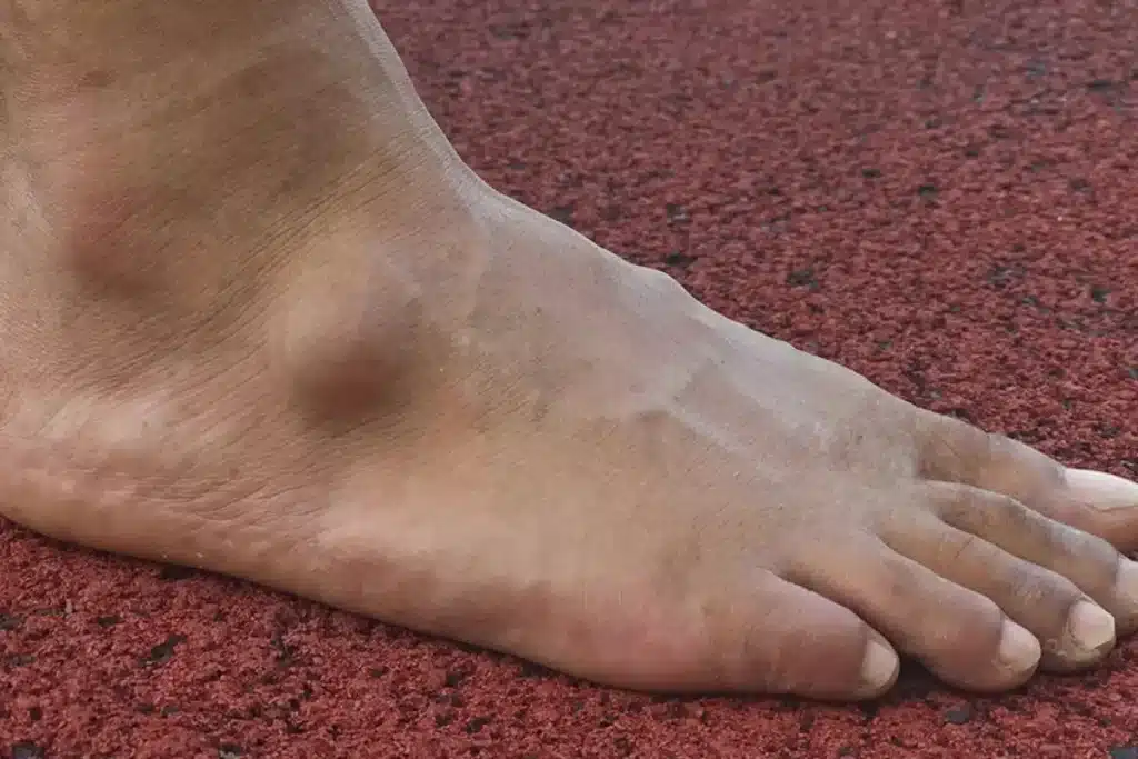 ganglion cyst