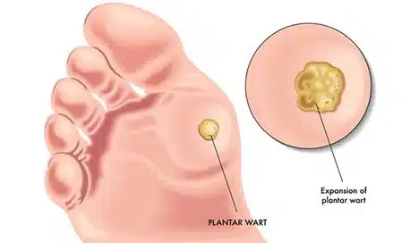 Plantar Warts Specialist NYC.jpg