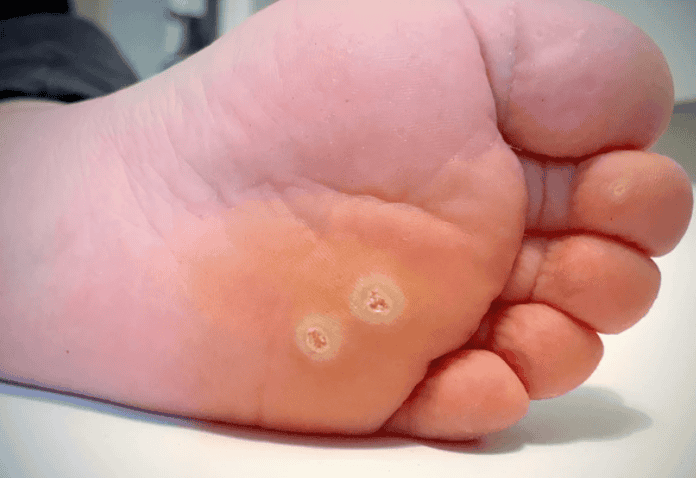 plantar warts