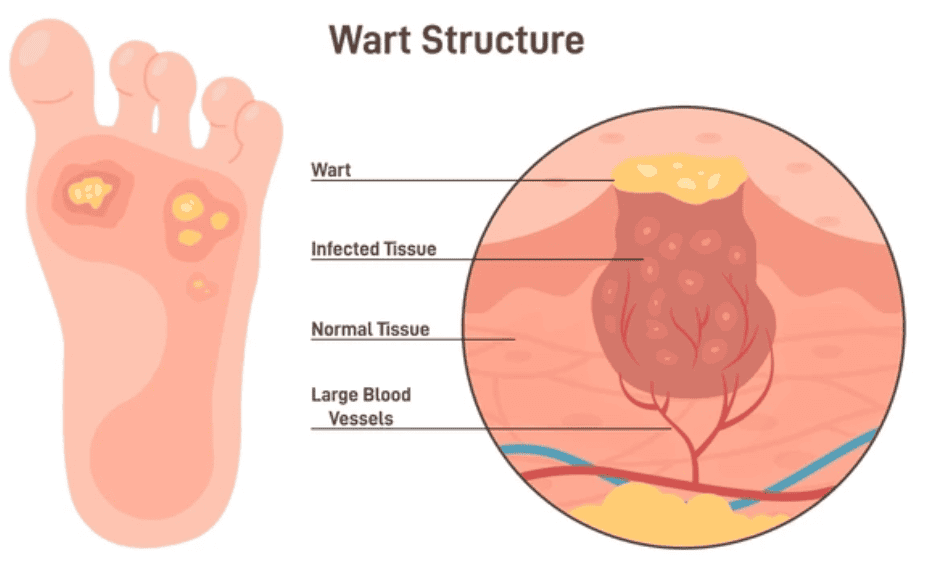 warts cartoon diagram