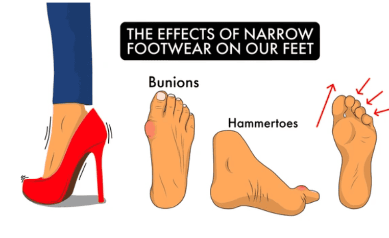 bunion and hammertoes cartoon and foot in heel shoes diagram