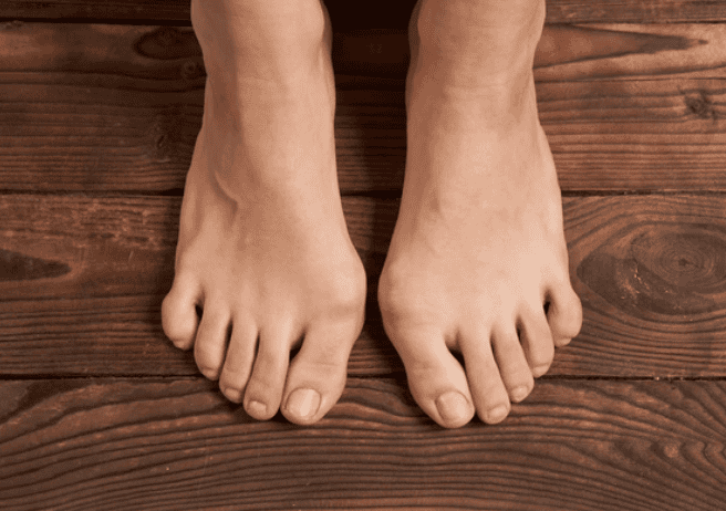 overview of bunions