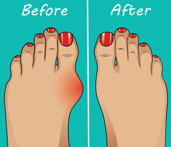 cartoon before and after of bunion treatment