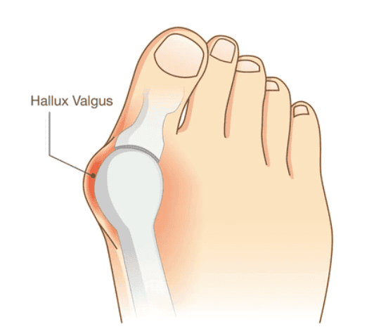 cartoon of hallux valgus